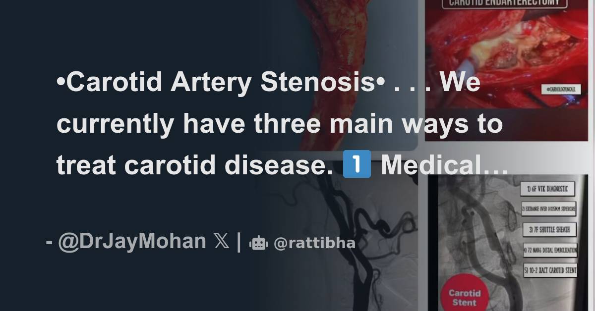 Carotid Artery Stenosis We Currently Have Three Main Ways To