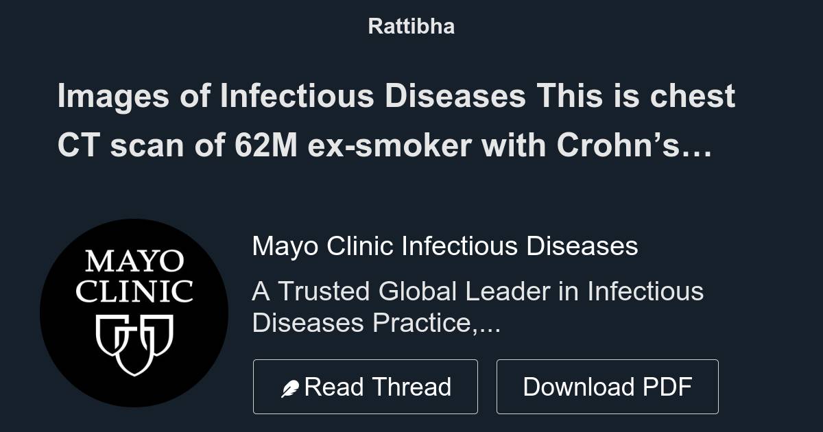 Images of Infectious Diseases This is chest CT scan of 62M exsmoker