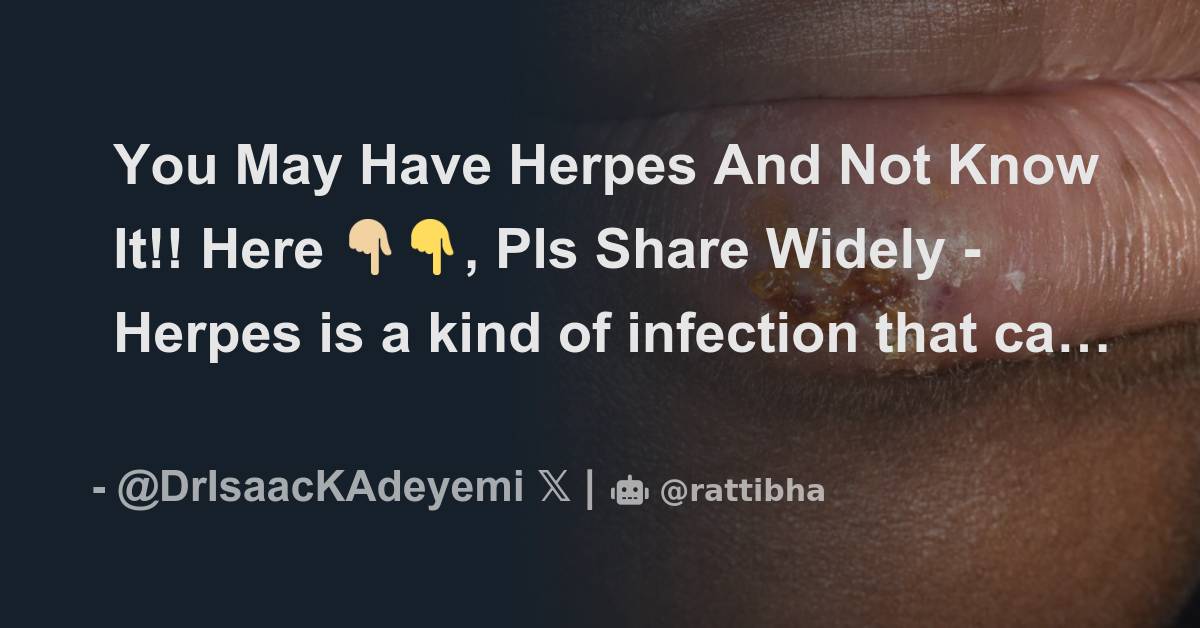 you-may-have-herpes-and-not-know-it-here-pls-share-widely