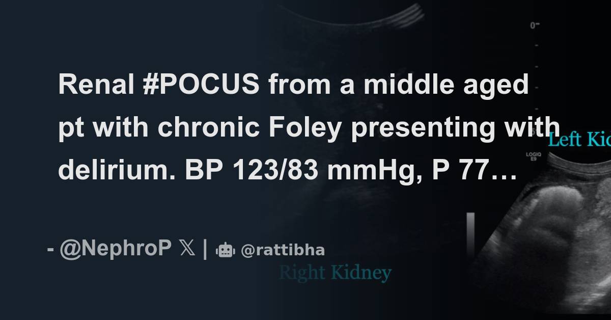 Renal POCUS from a middle aged pt with chronic Foley presenting with