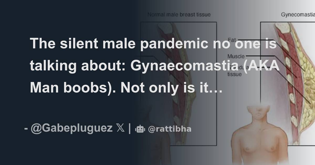 The silent male pandemic no one is talking about: Gynaecomastia (AKA
